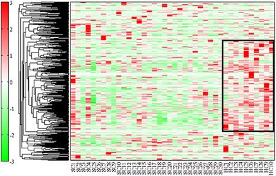 A Metabolomics Study of Serum in Hospitalized Patients With Chronic Schizophrenia